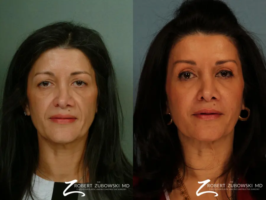 Brow Lift: Patient 4 - Before and After  