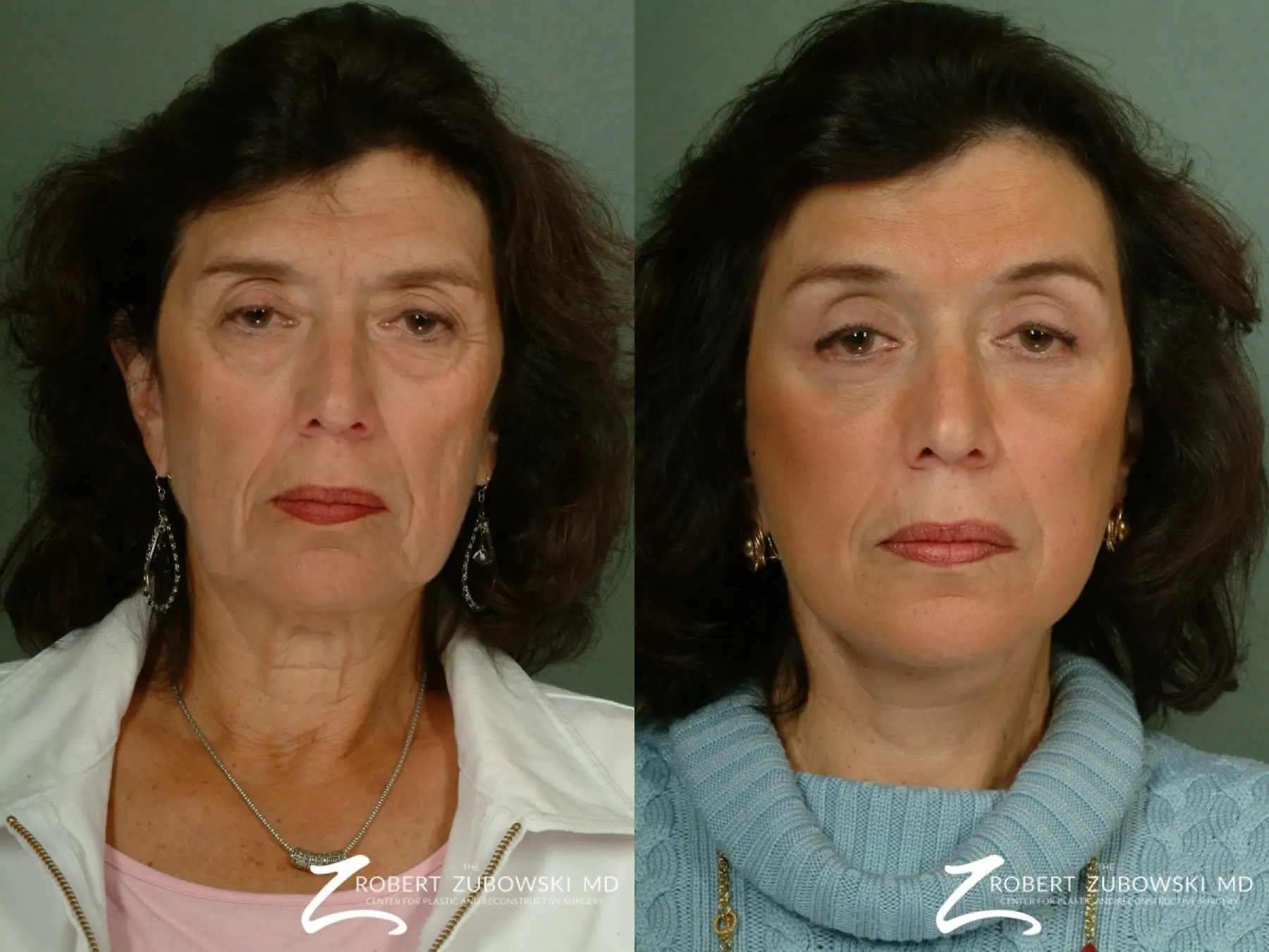 Brow Lift: Patient 5 - Before and After  