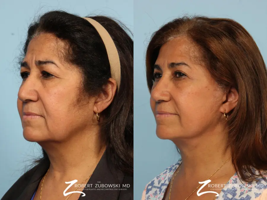 Brow Lift: Patient 7 - Before and After 2