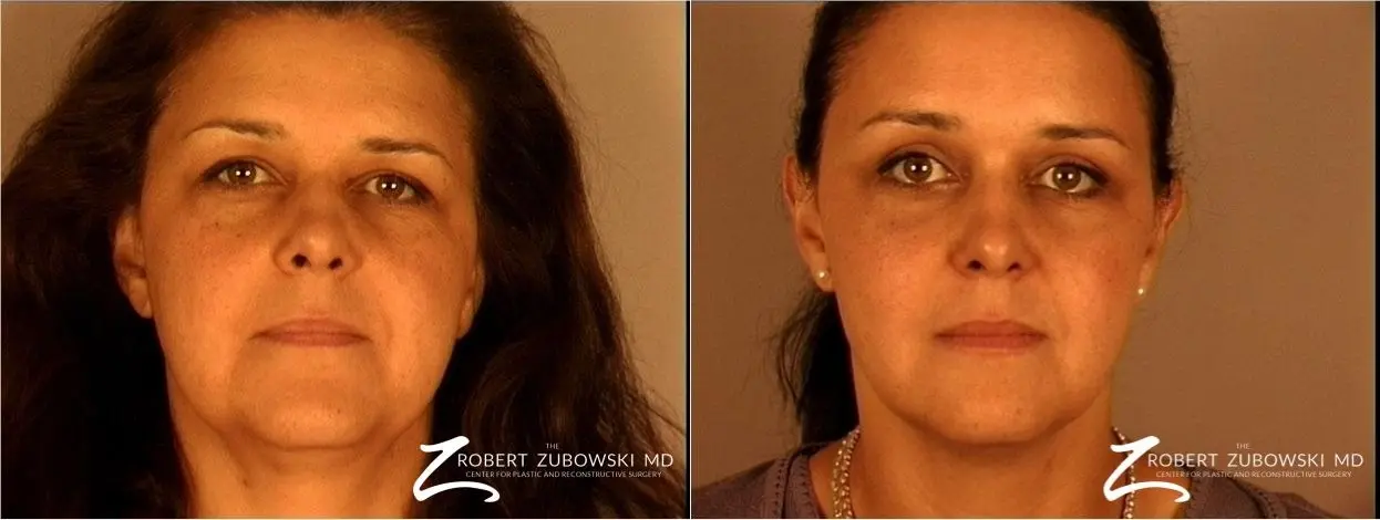 Brow Lift: Patient 9 - Before and After 1