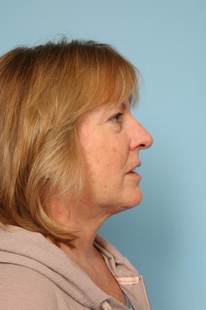 Mohs Closure: Patient 1 - After Image 3