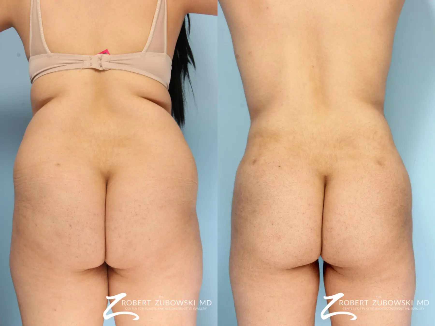 Butt Augmentation: Patient 4 - Before and After 1