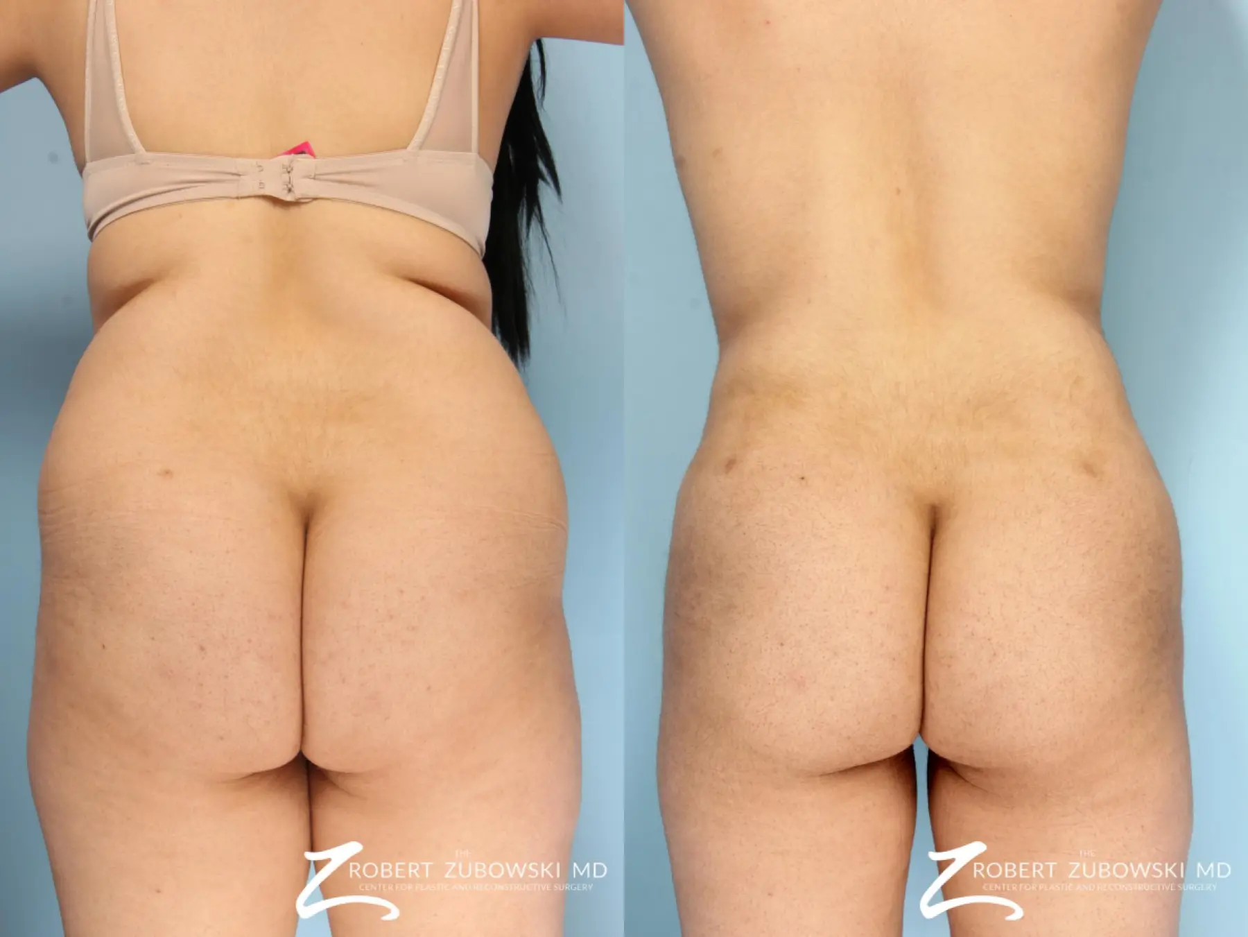 https://www.bragbook.gallery/assets/gallery/108/butt-augmentation-before-and-after-5ys35JrpUJ6G_highres.webp