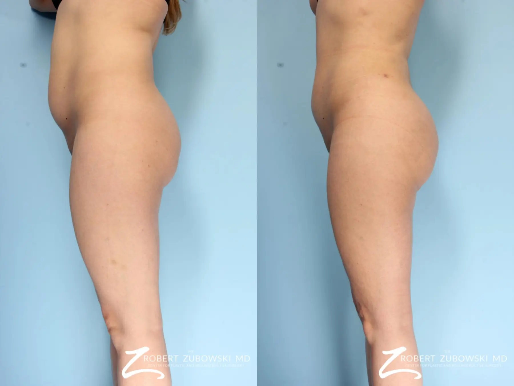 Butt Augmentation: Patient 3 - Before and After  