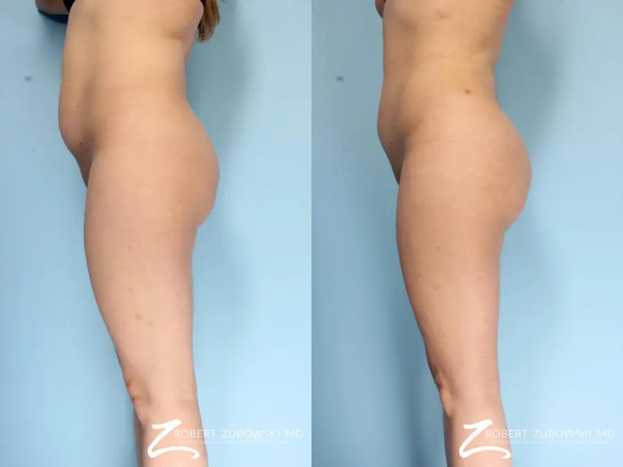 Butt Augmentation: Patient 2 - Before and After  