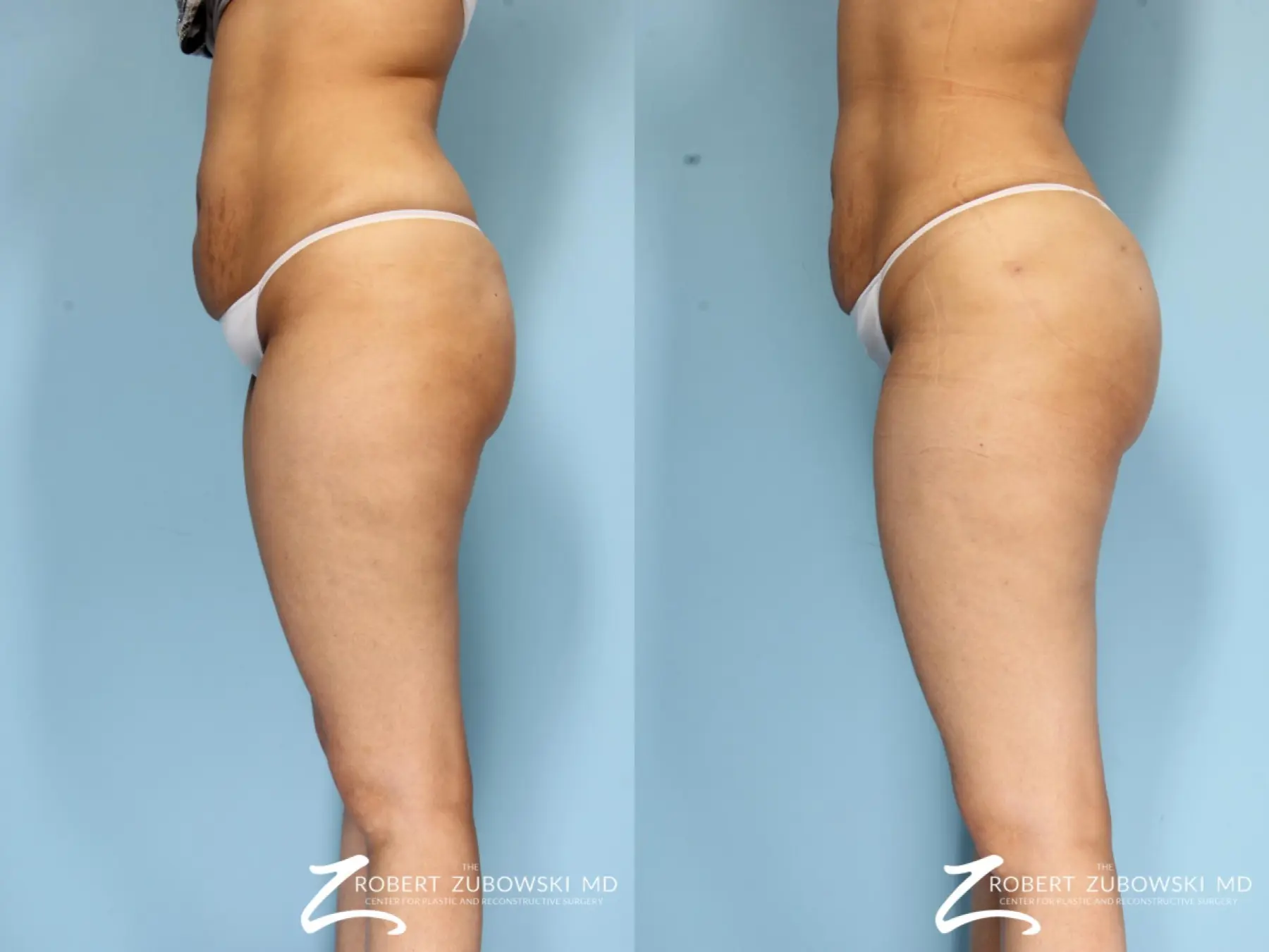 Butt Augmentation: Patient 2 - Before and After  