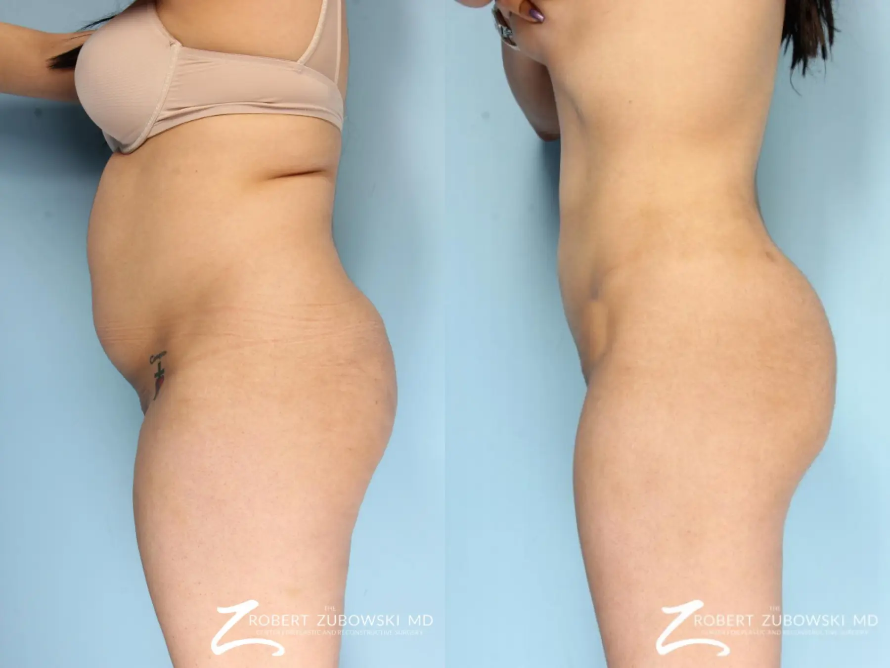 Butt Augmentation: Patient 4 - Before and After 2