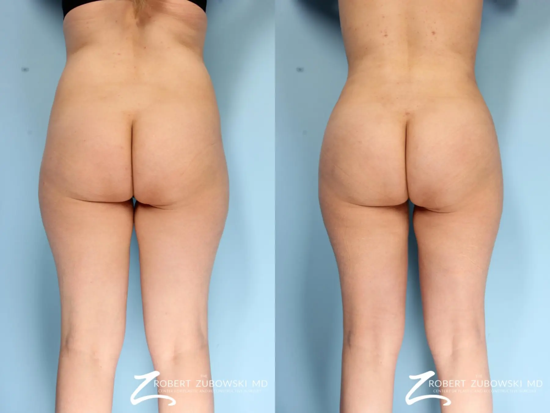 Butt Augmentation: Patient 3 - Before and After 2