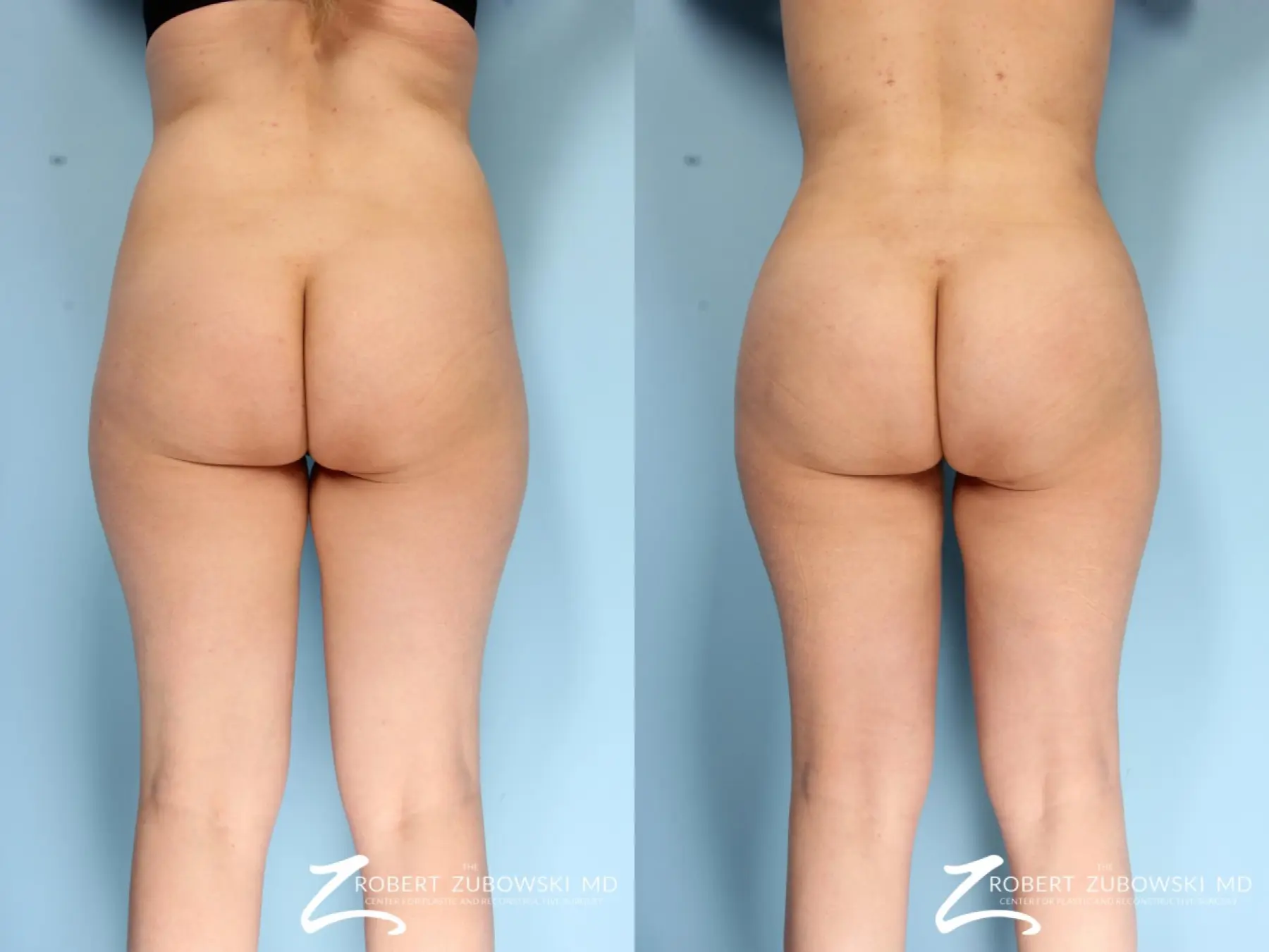 https://www.bragbook.gallery/assets/gallery/108/butt-augmentation-before-and-after-eq64HU05bKcs_highres.webp