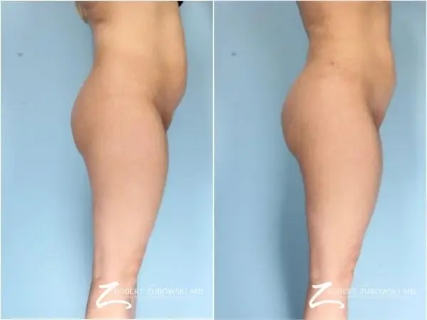 Butt Augmentation: Patient 1 - Before and After  