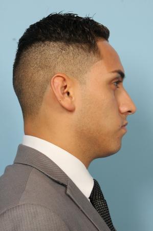 Rhinoplasty: Patient 3 - Before and After Image 2