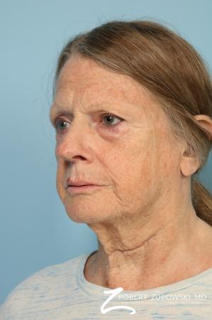 Blepharoplasty: Patient 38 - Before and After Image 2