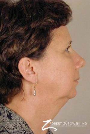 Facelift: Patient 8 - Before and After Image 2