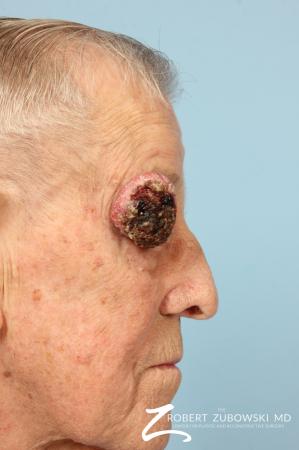 Mohs Closure: Patient 7 - Before and After Image 3