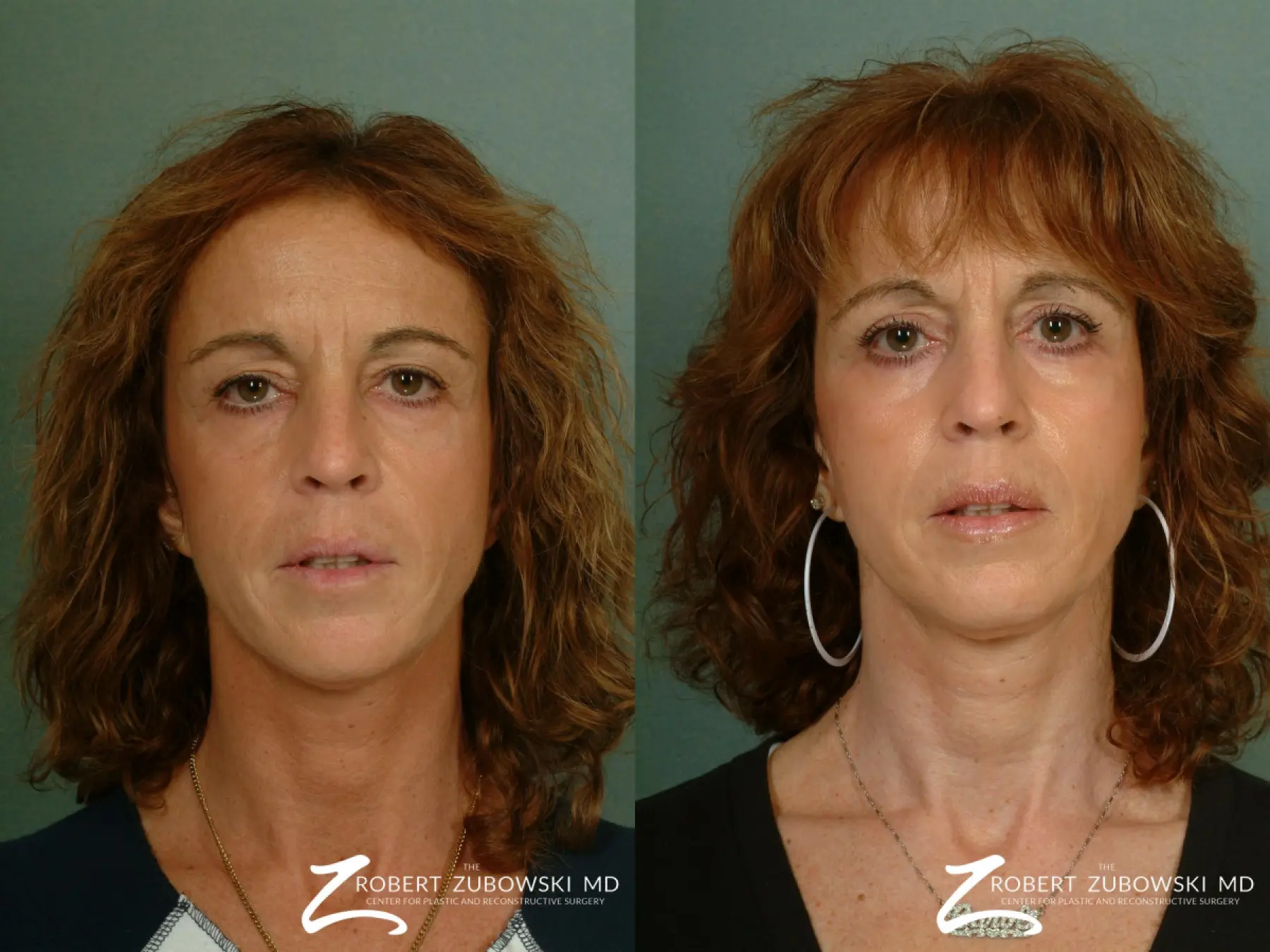 Chemical Peel: Patient 1 - Before and After  