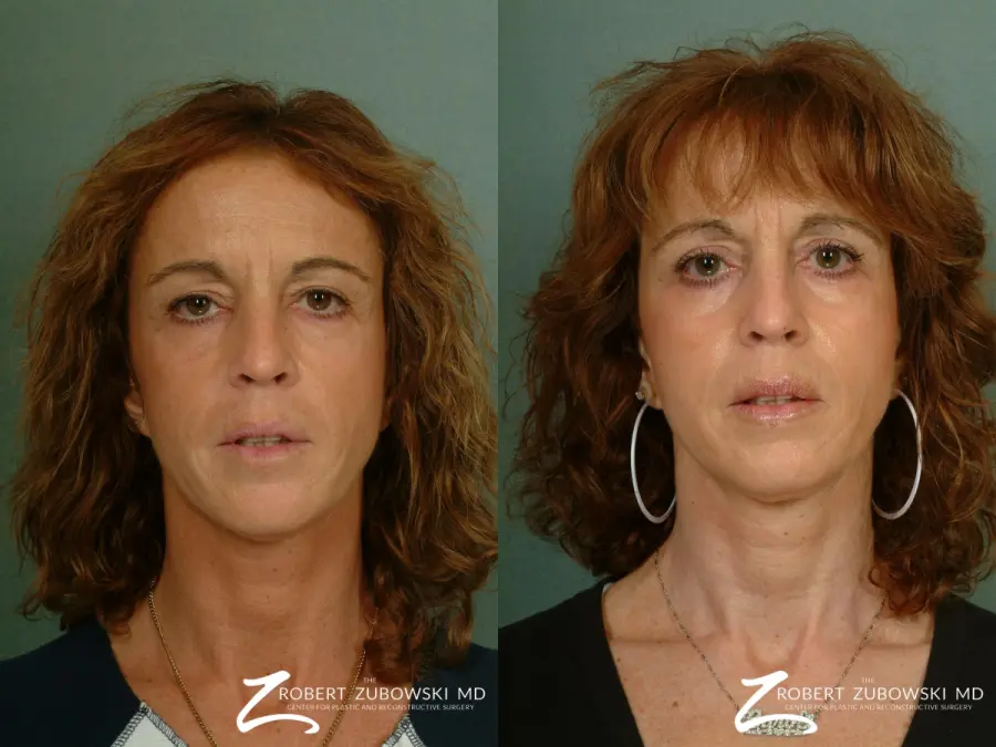 Chemical Peel: Patient 3 - Before and After 1