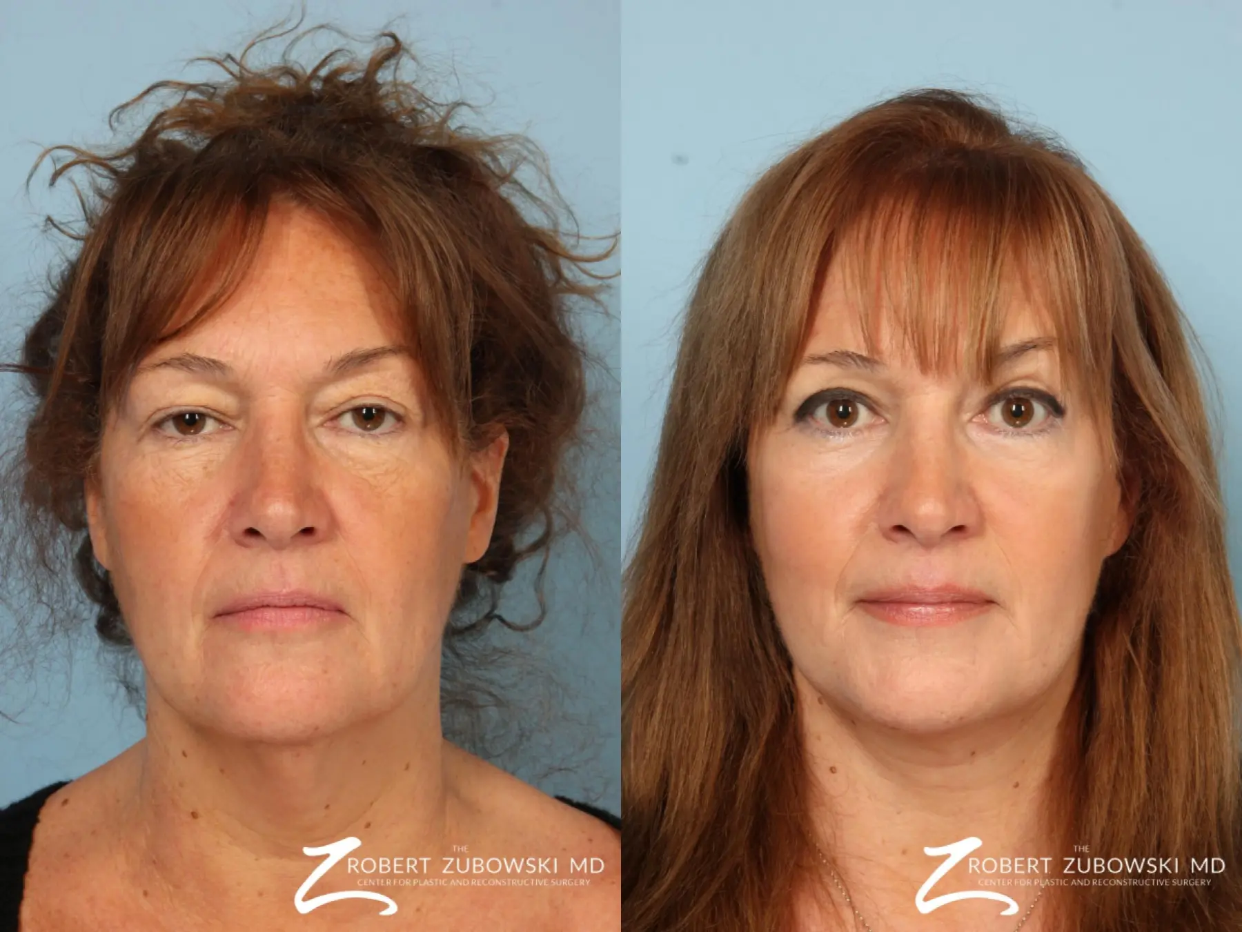 Chemical Peel: Patient 3 - Before and After  