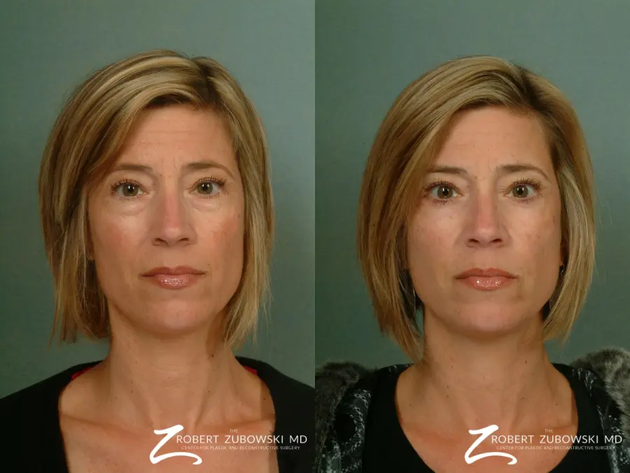 Chemical Peel: Patient 1 - Before and After  