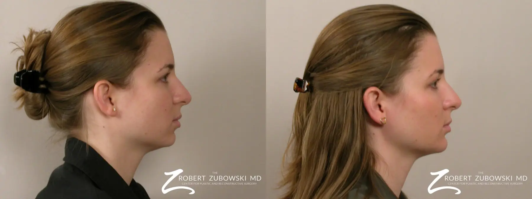Chin Augmentation: Patient 4 - Before and After 2
