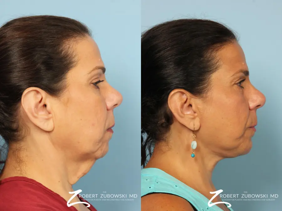 Chin Augmentation: Patient 4 - Before and After 2