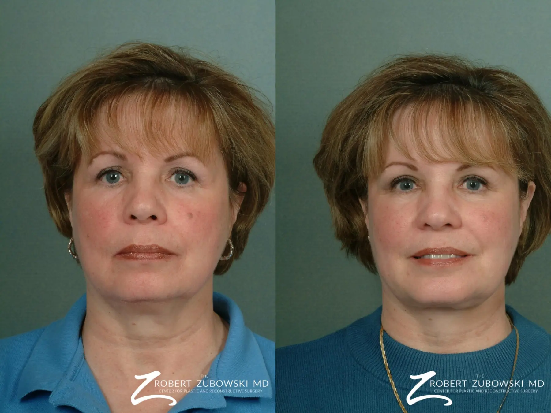 Chin Augmentation: Patient 1 - Before and After