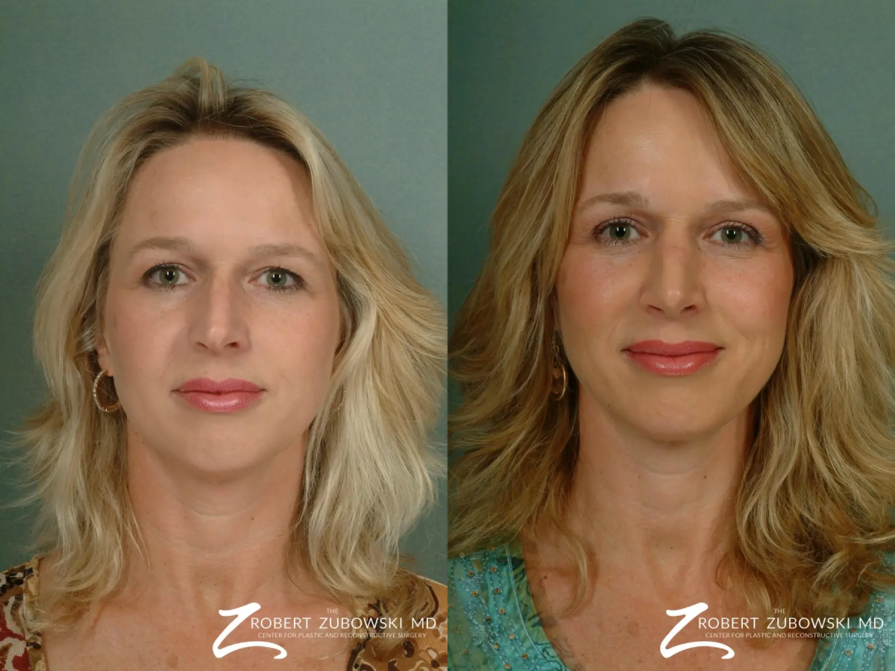 Chin Augmentation: Patient 2 - Before and After