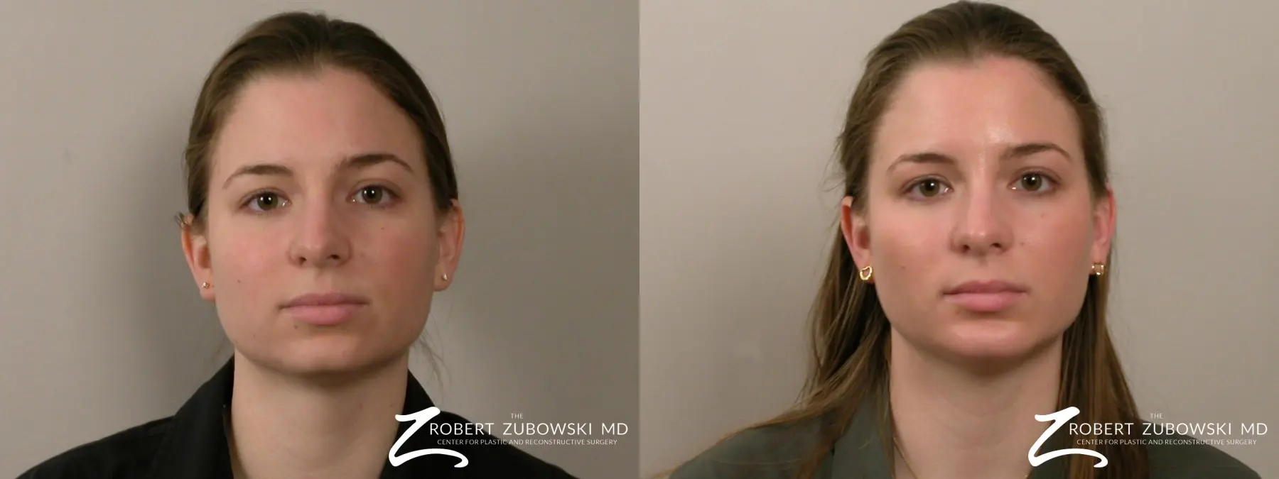 Chin Augmentation: Patient 4 - Before and After 1