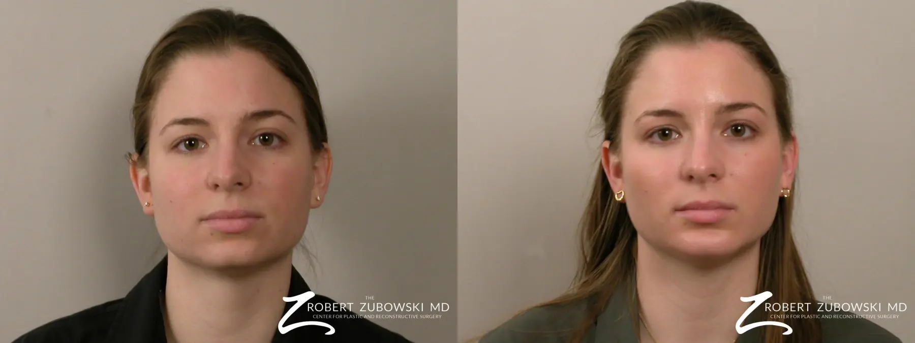 Chin Augmentation: Patient 4 - Before and After  