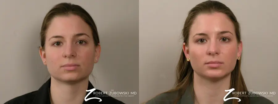 Chin Augmentation: Patient 1 - Before and After  