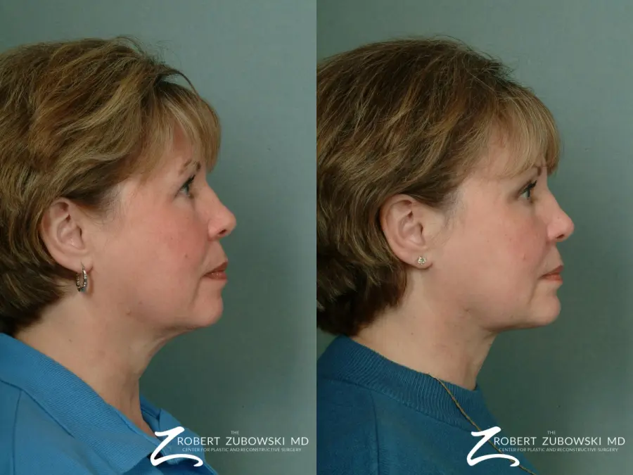 Chin Augmentation: Patient 2 - Before and After 2