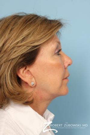Facelift: Patient 18 - After Image 2