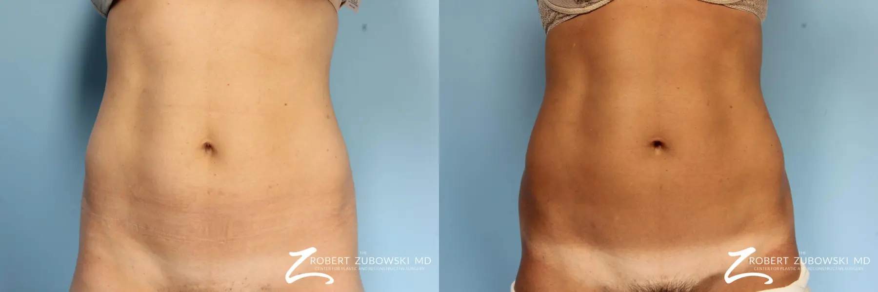 CoolSculpting®: Patient 4 - Before and After 1