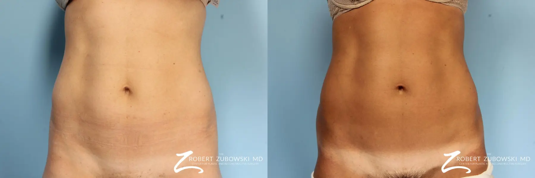 CoolSculpting®: Patient 4 - Before and After  