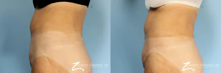 CoolSculpting®: Patient 1 - Before and After 4