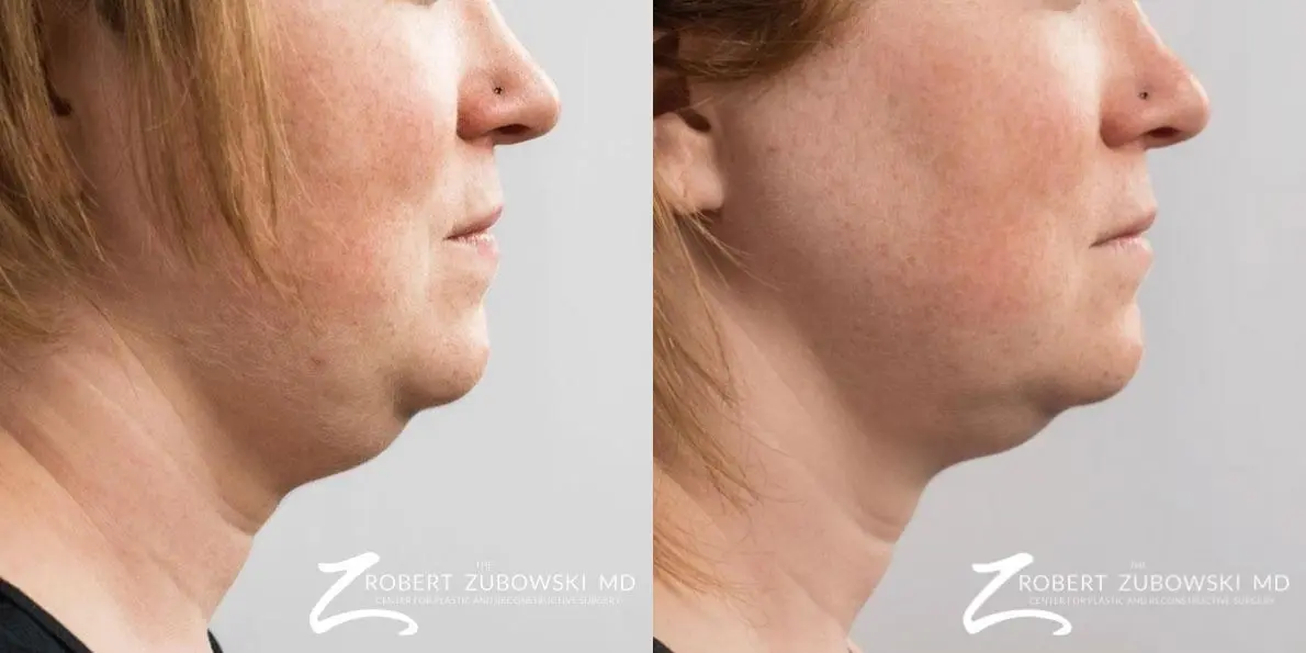 CoolSculpting®: Patient 6 - Before and After 2