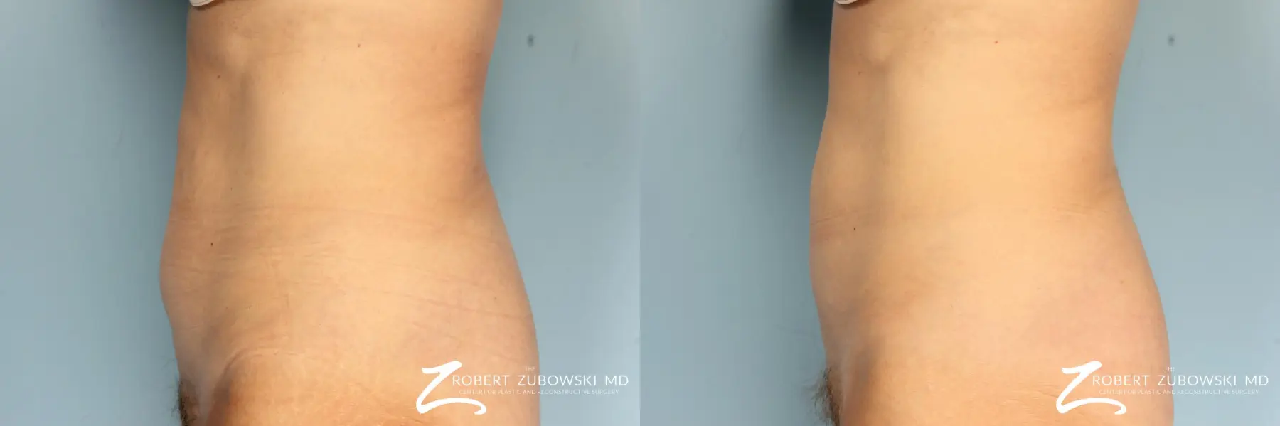 CoolSculpting®: Patient 3 - Before and After 2
