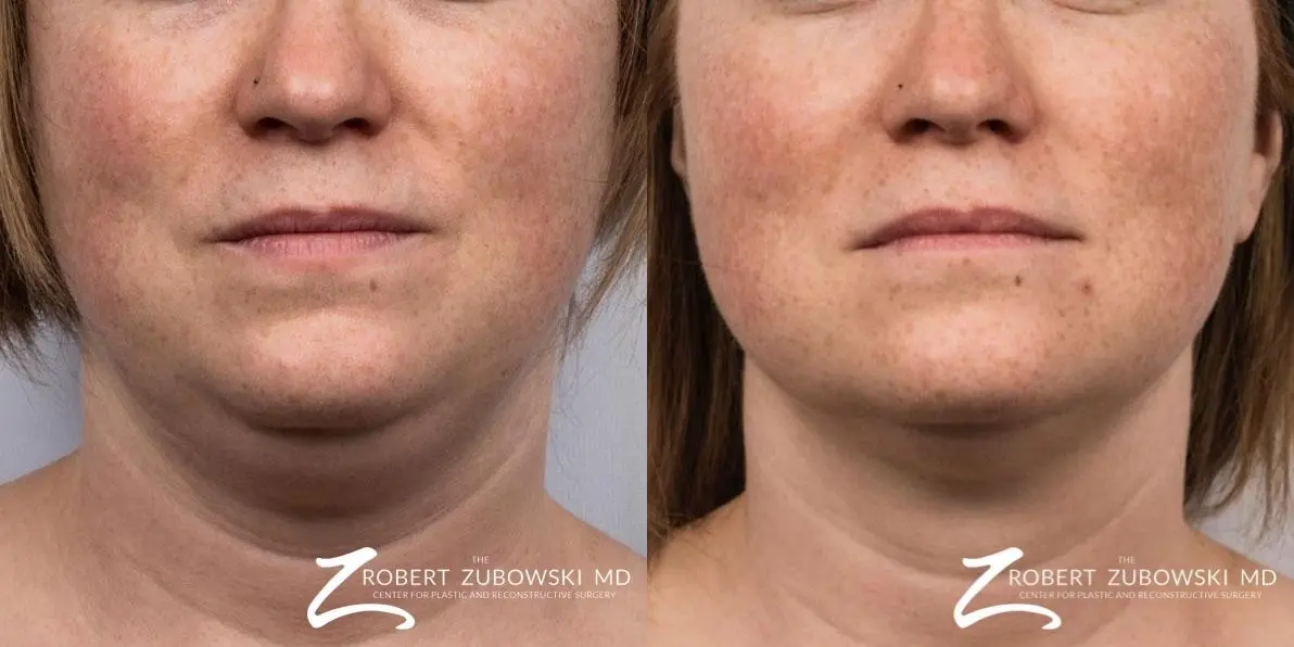 CoolSculpting®: Patient 6 - Before and After  