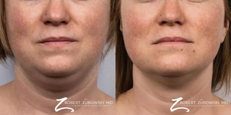 CoolSculpting®: Patient 6 - Before and After  