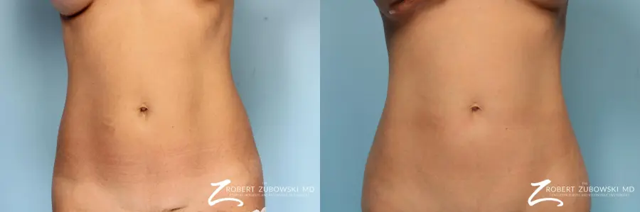 CoolSculpting®: Patient 5 - Before and After 2