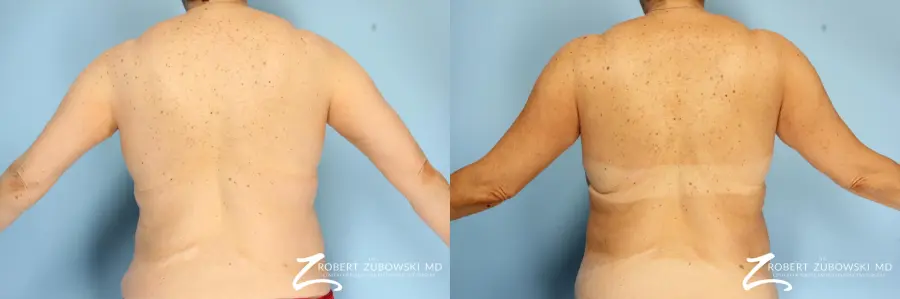 CoolSculpting®: Patient 1 - Before and After 3