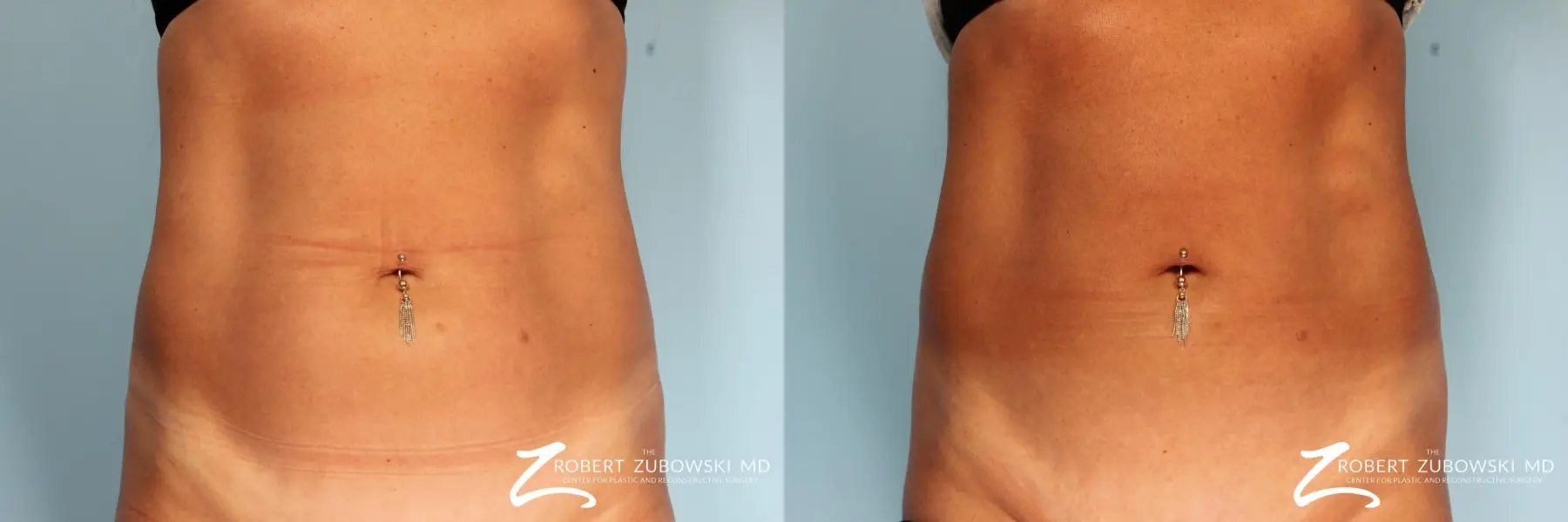 CoolSculpting®: Patient 2 - Before and After  