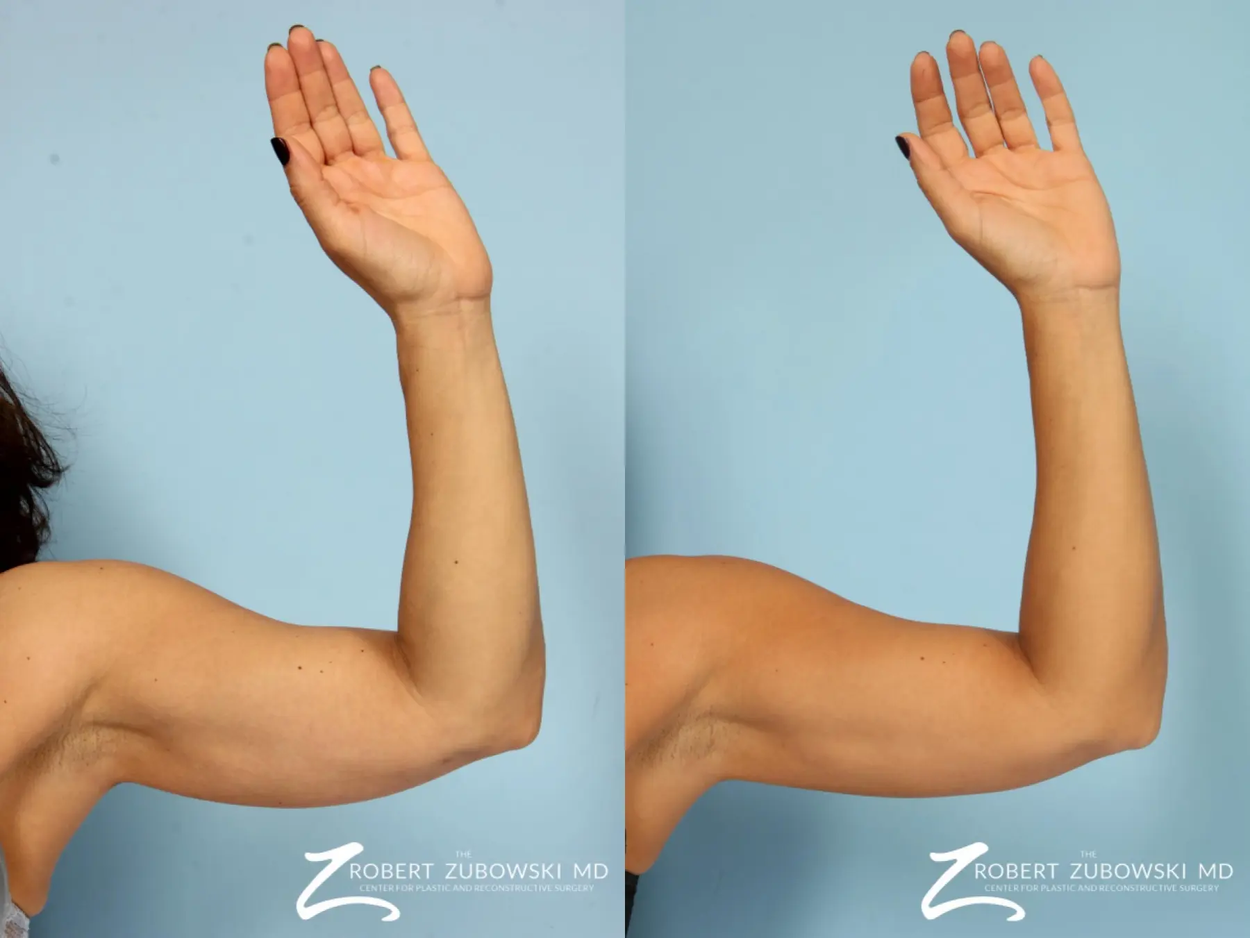 https://www.bragbook.gallery/assets/gallery/108/coolsculpting-before-and-after-MgK21jeZJpKS_highres.webp