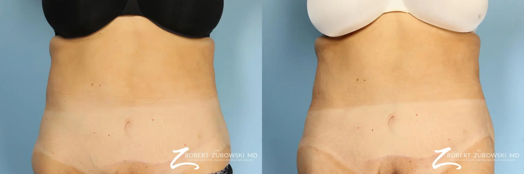 CoolSculpting®: Patient 1 - Before and After  