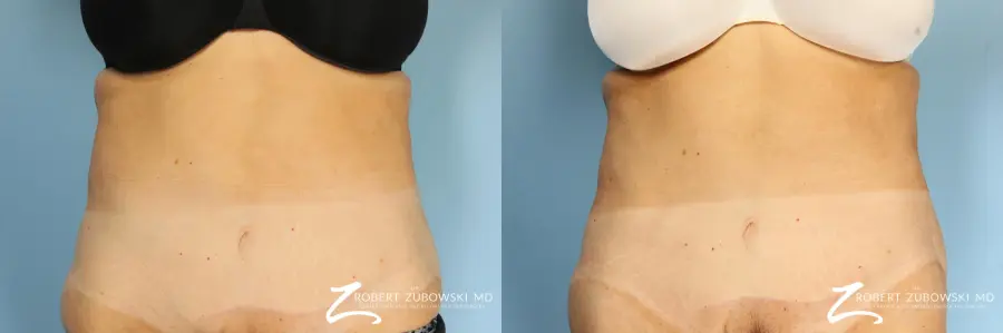 CoolSculpting®: Patient 2 - Before and After  