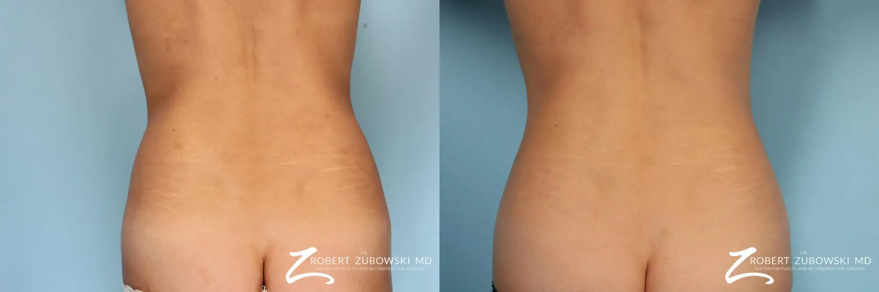 CoolSculpting®: Patient 5 - Before and After 1