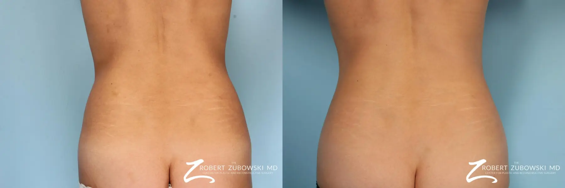 CoolSculpting®: Patient 5 - Before and After  