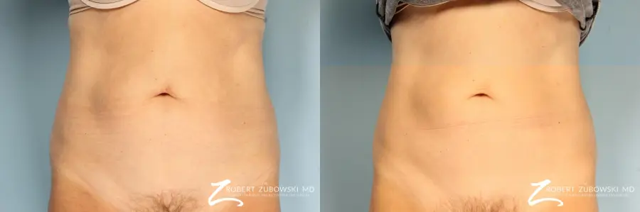 CoolSculpting®: Patient 4 - Before and After  