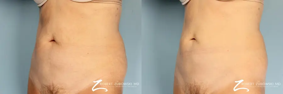 CoolSculpting®: Patient 3 - Before and After 3