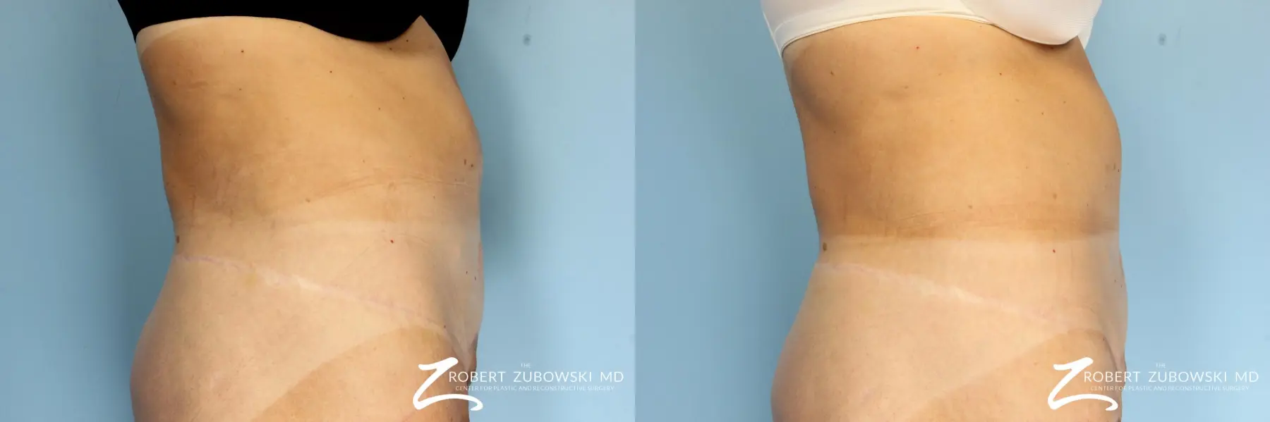 CoolSculpting®: Patient 1 - Before and After 2