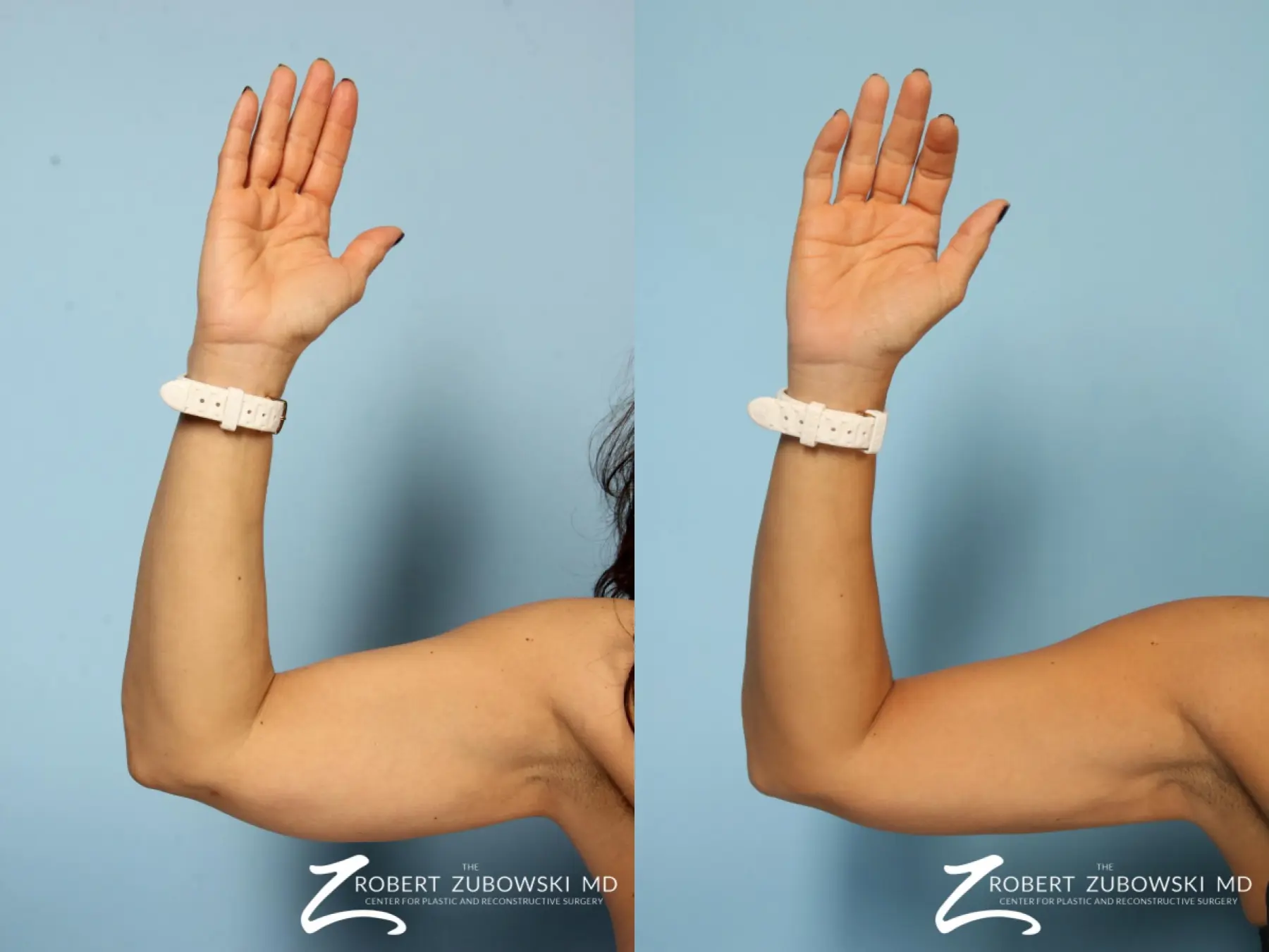 CoolSculpting®: Patient 7 - Before and After 2